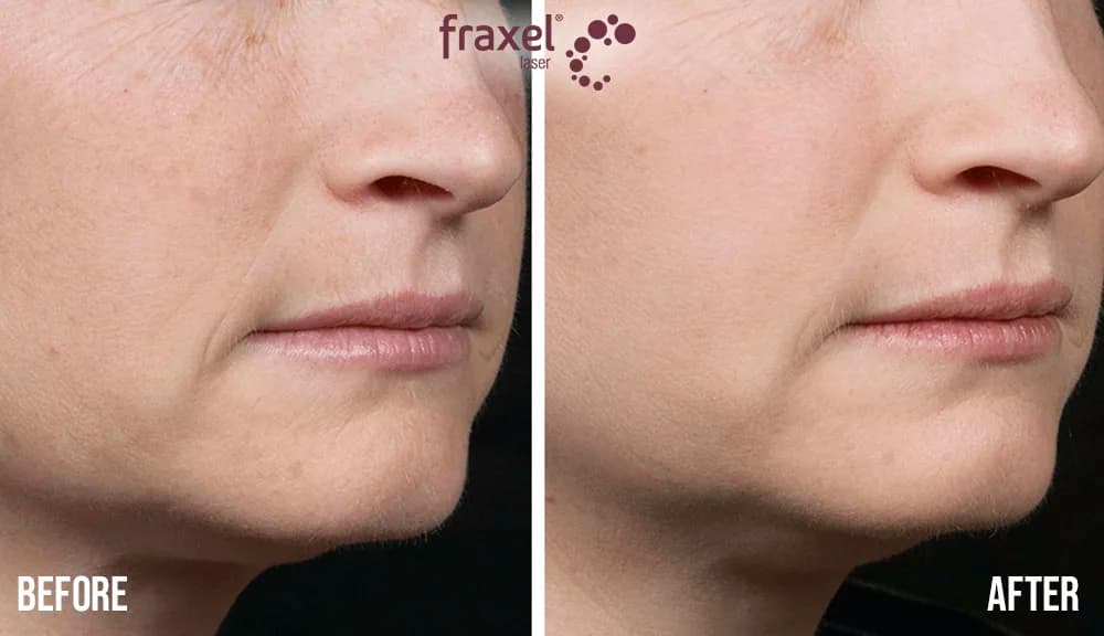 What Can Fraxel Laser Treat? at The Dermatology, Laser & Vein Center in Cincinnati