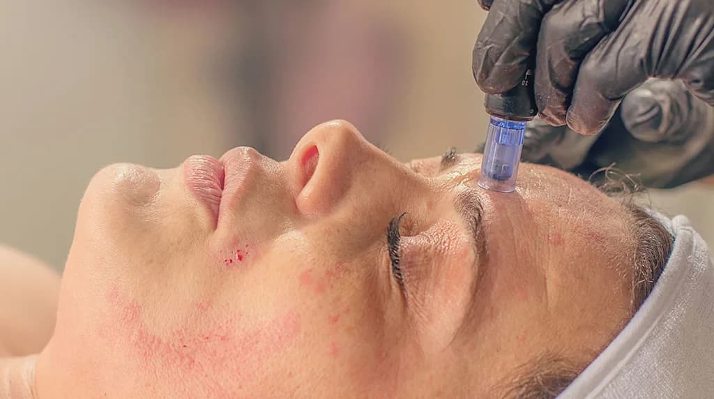 What Can Microneedling Treat? at The Dermatology, Laser & Vein Center in Cincinnati