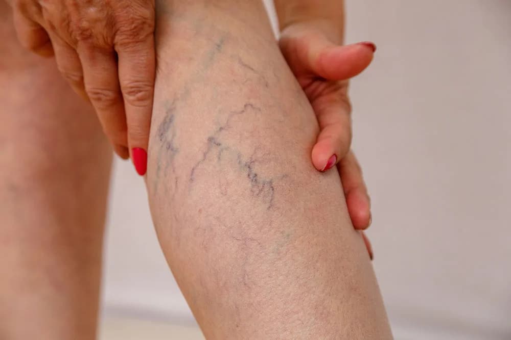 What is the Best Treatment for Veins? at The Dermatology, Laser & Vein Center in Cincinnati