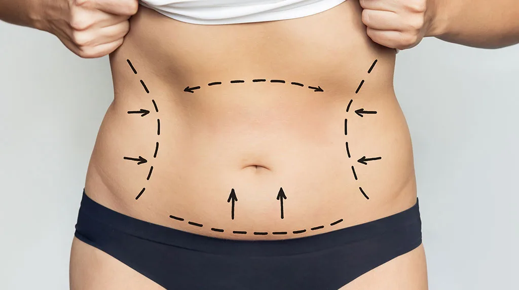 What Is the Weight Requirement for a Tummy Tuck? at The Dermatology, Laser & Vein Center in Cincinnati