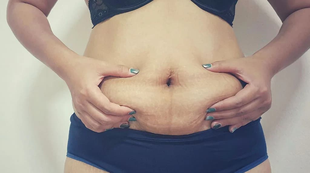 Will My Belly Be Flat After a Tummy Tuck? at The Dermatology, Laser & Vein Center in Cincinnati