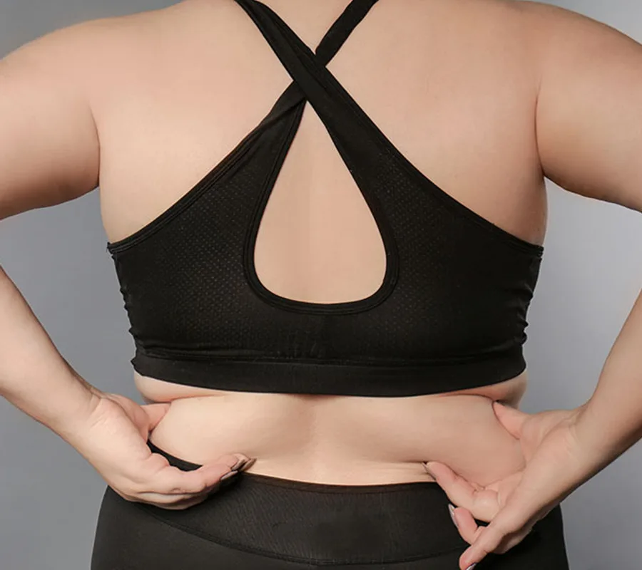 Back and bra line of a woman in a sports bra, an area Vaser liposuction is used to reduce