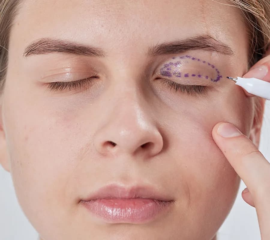 Surgical marking pen outlining the excess skin on a patient's upper eyelid before blepharoplasty