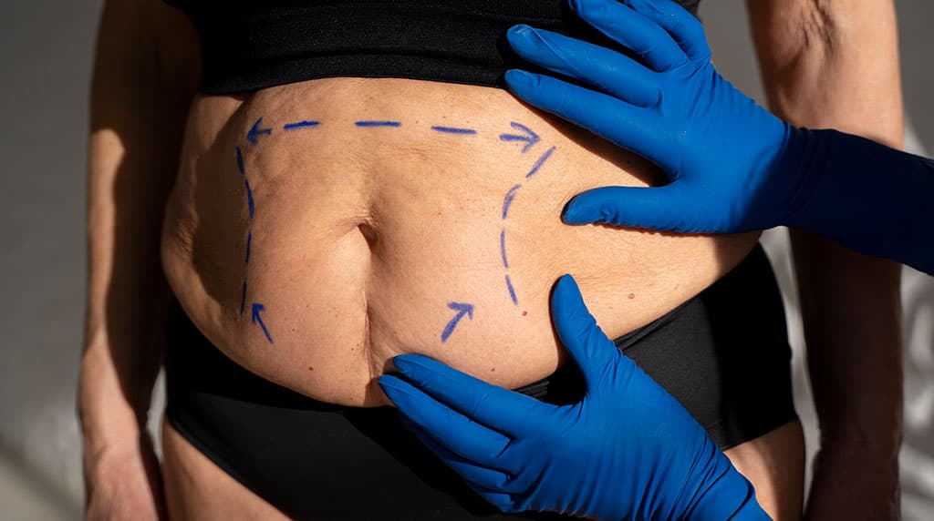 Surgeon marking the abdominal incision plan before a tummy tuck in Cincinnati
