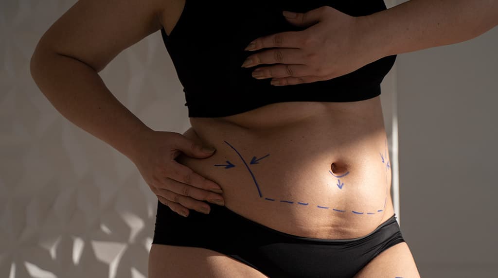 Abdomen with pre-surgical markings showing where a tummy tuck incision sits