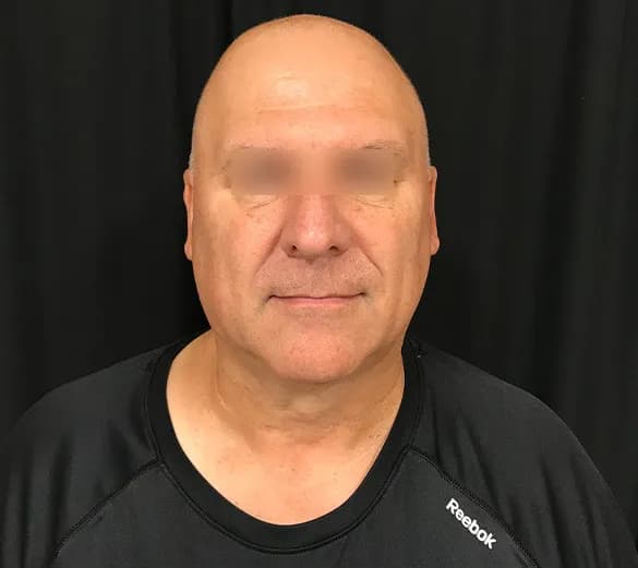 AccuTite, jawline and lower face, male patient, after