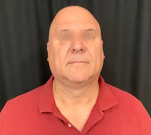AccuTite, jawline and lower face, male patient, before