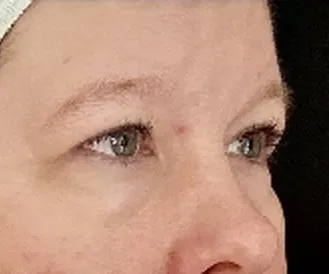 AccuTite, under-eye area, after