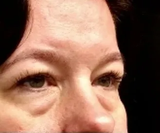 AccuTite, under-eye area, before
