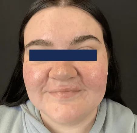 AviClear, full face, after