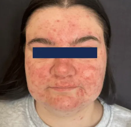 AviClear, full face, before
