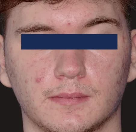 AviClear, full face, after