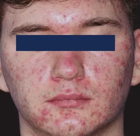 AviClear, full face, before