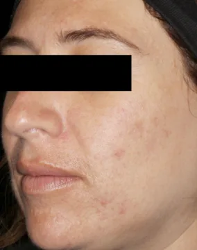AviClear, cheek acne, three months after the final session, after