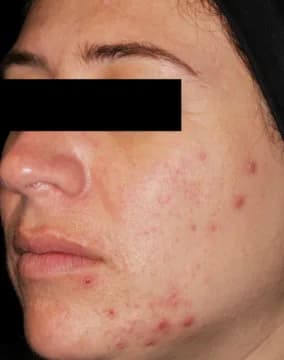 AviClear, cheek acne, three months after the final session, before