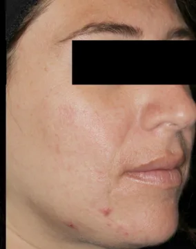 AviClear, inflamed cheek acne, three months after the final session, after