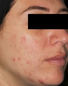 AviClear, inflamed cheek acne, three months after the final session, before