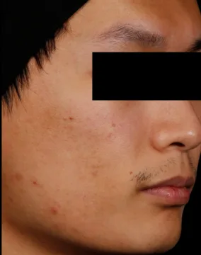 AviClear, severe cheek acne, two years after the final session, after
