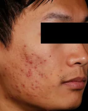 AviClear, severe cheek acne, two years after the final session, before