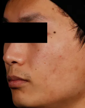 AviClear, cystic acne, two years after the final session, after