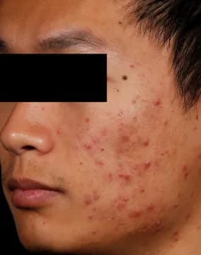 AviClear, cystic acne, two years after the final session, before