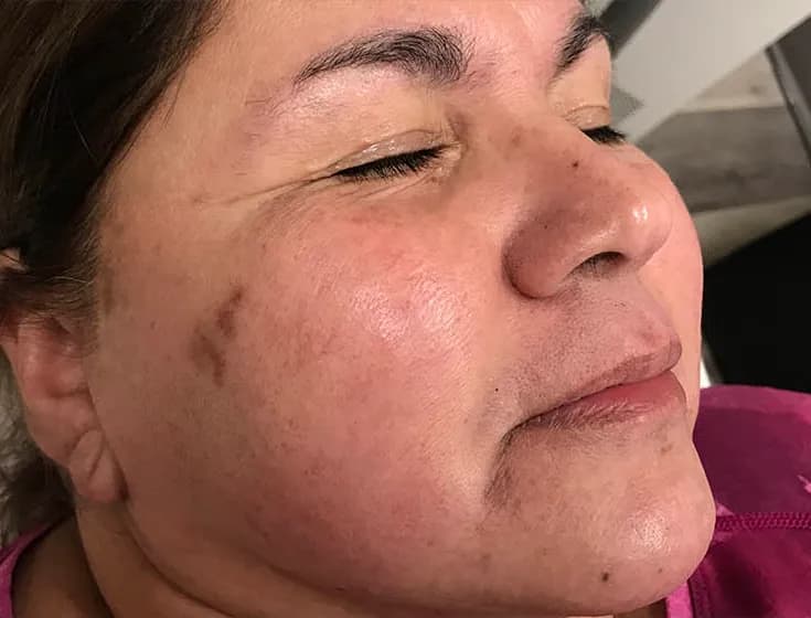 BBL for melasma, oblique view, after