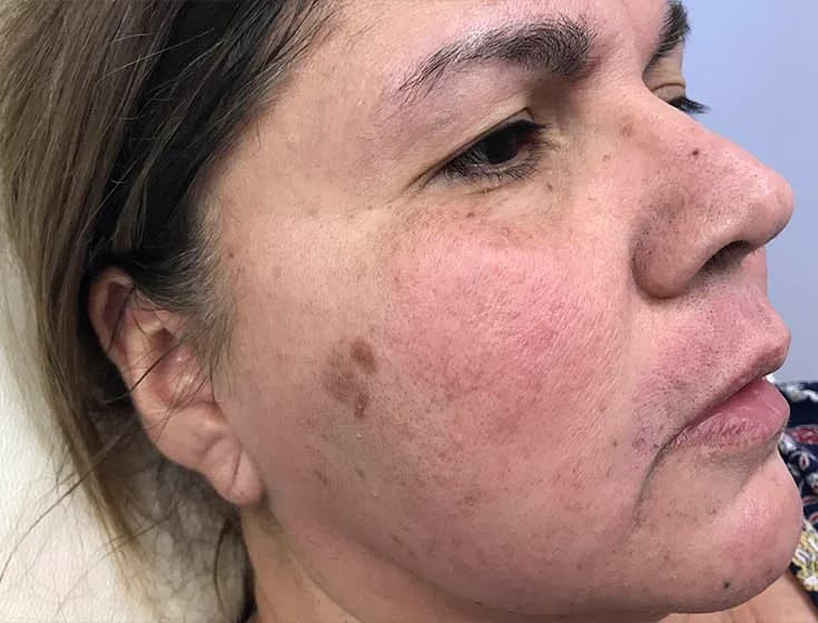 BBL for melasma, oblique view, before