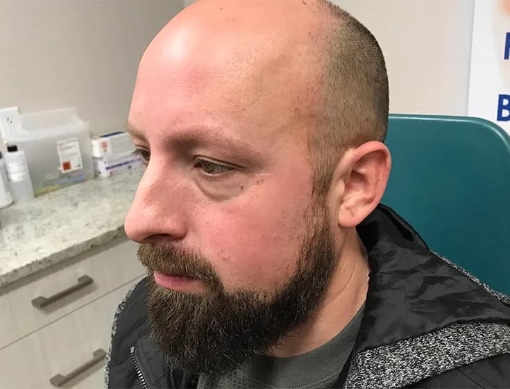 BBL, male facial redness, after