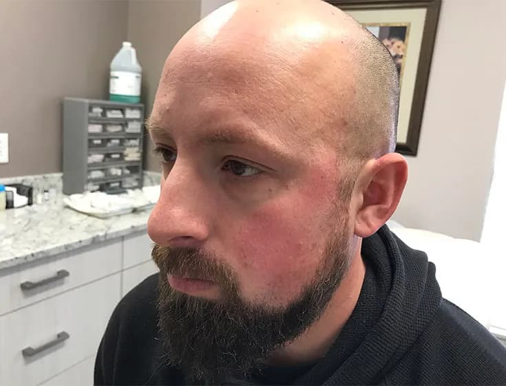 BBL, male facial redness, before