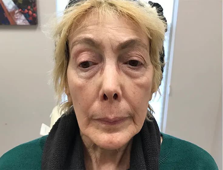 BBL photorejuvenation, full face, after