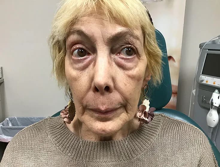 BBL photorejuvenation, full face, before