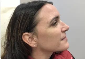 BBL, side profile, after