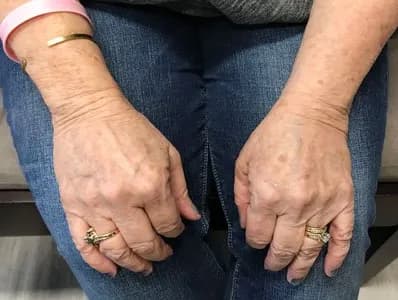 BBL for sun spots on the hands, after