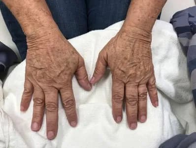 BBL for sun spots on the hands, before
