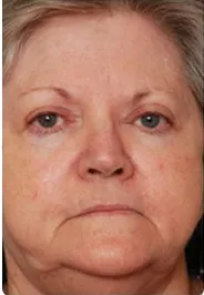 BBL, full face photorejuvenation, after