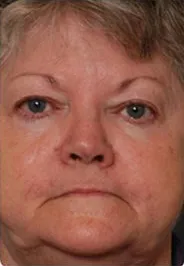 BBL, full face photorejuvenation, before