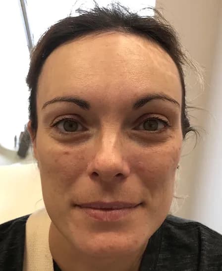 BBL for melasma, front view, after