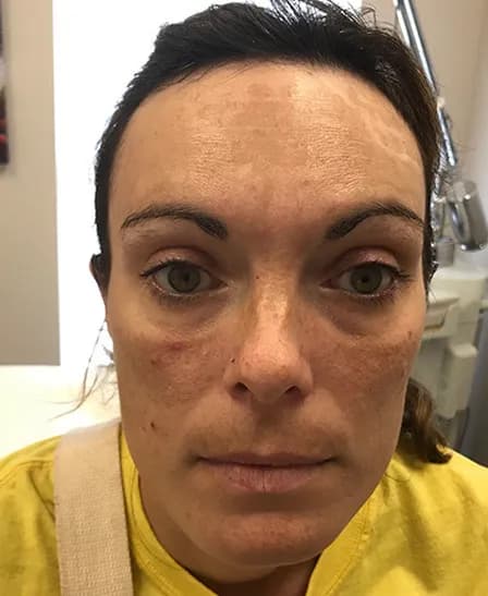 BBL for melasma, front view, before