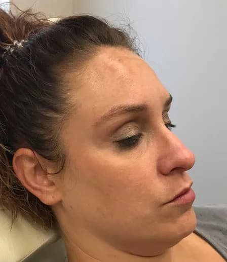 BBL for melasma, side view, after