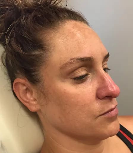 BBL for melasma, side view, before