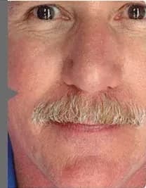 BBL for facial redness and rosacea, after