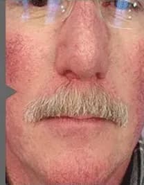 BBL for facial redness and rosacea, before