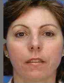 BBL for sun damage, full face, after