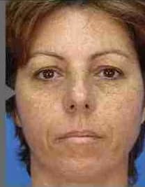 BBL for sun damage, full face, before