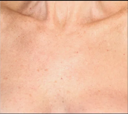 BBL for sun damage on the chest, after