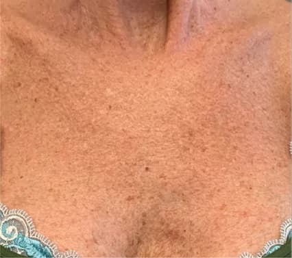 BBL for sun damage on the chest, before
