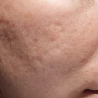 Bellafill for acne scars, 12 months after treatment, after