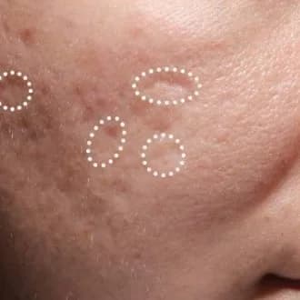 Bellafill for acne scars, 12 months after treatment, before