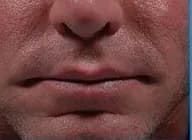 Bellafill for smile lines, five years after treatment, after
