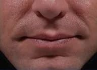 Bellafill for smile lines, five years after treatment, before